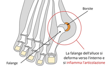 Alluce valgo dott La Bella Luigi PODOLOGO