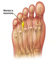 Neuroma di Morton dott La Bella Luigi PODOLOGO