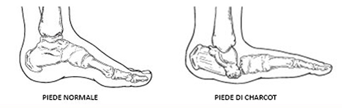 Piede di Charcot dott La Bella Luigi PODOLOGO