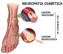 Piede diabetico dott La Bella Luigi PODOLOGO