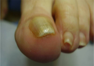 Onicaussi da microtrauma dott La Bella Luigi PODOLOGO